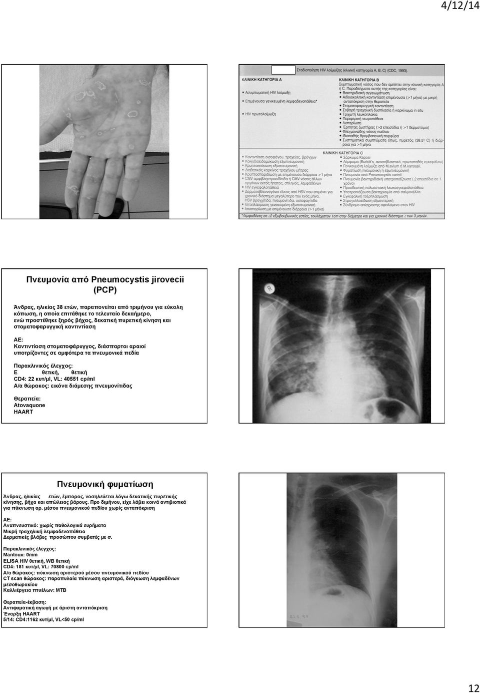 22 κυτ/µl, VL: 40551 cp/ml Α/α θώρακος: εικόνα διάµεσης πνευµονίτιδας Θεραπεία: Αtovaquone ΗΑΑRT Πνευµονική φυµατίωση Άνδρας, ηλικίας 36 ετών, έµπορος, νοσηλεύεται λόγω δεκατικής πυρετικής κίνησης,