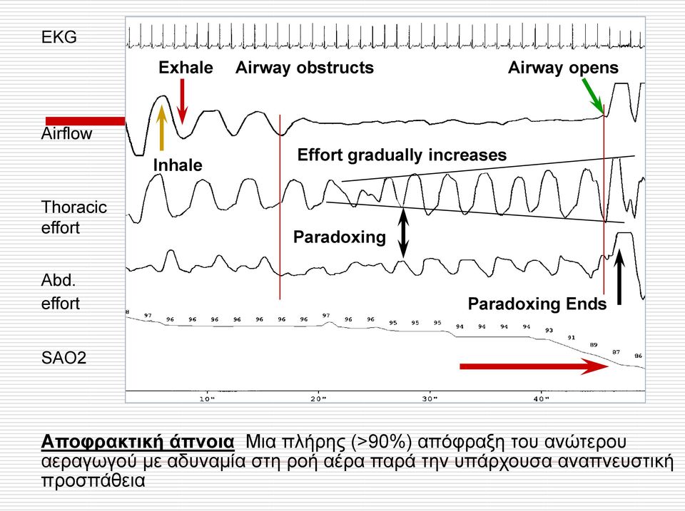 SAO2 Αποφρακτική άπνοια Μια πλήρης (>90%) απόφραξη του ανώτερου