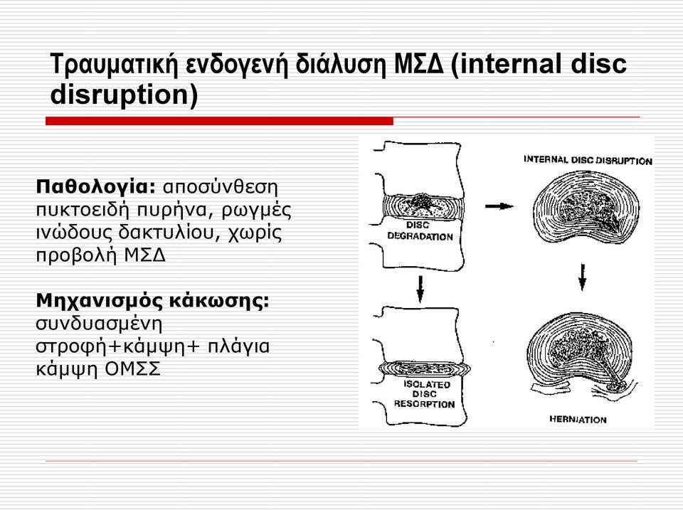 ρωγμές ινώδους δακτυλίου, χωρίς προβολή ΜΣΔ