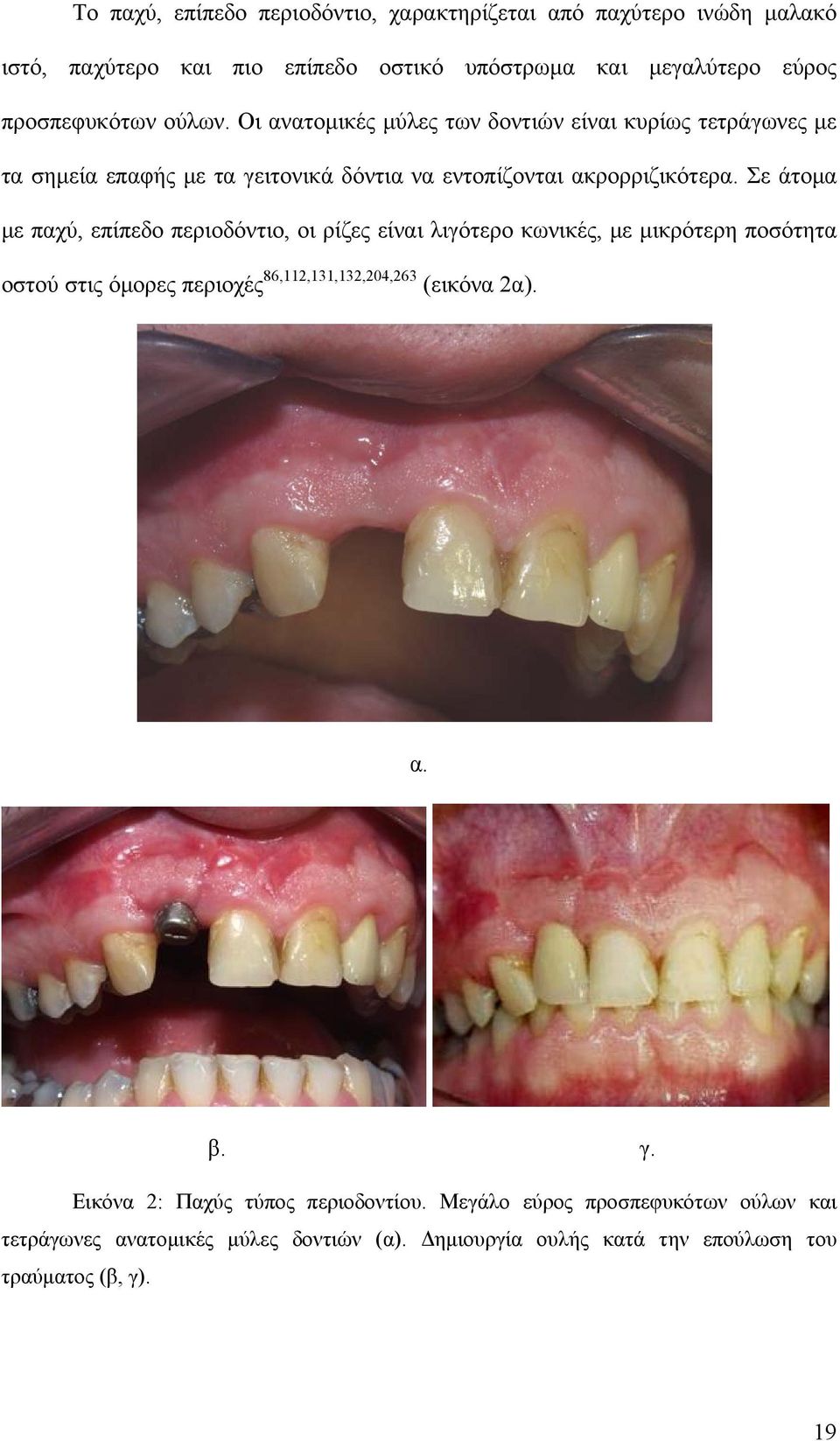 Σε άτομα με παχύ, επίπεδο περιοδόντιο, οι ρίζες είναι λιγότερο κωνικές, με μικρότερη ποσότητα οστού στις όμορες περιοχές 86,112,131,132,204,263 (εικόνα 2α).