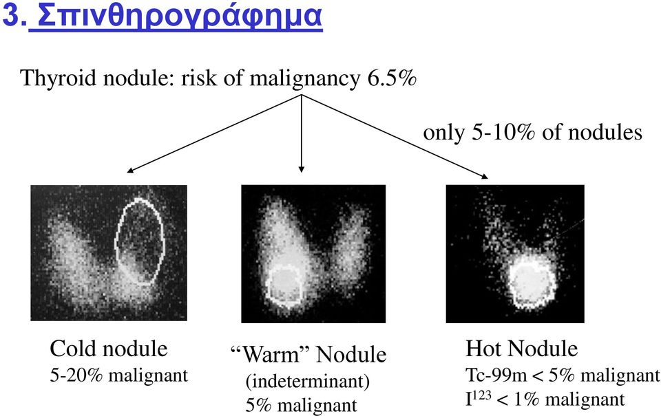 5% only 5-10% of nodules Cold nodule 5-20%
