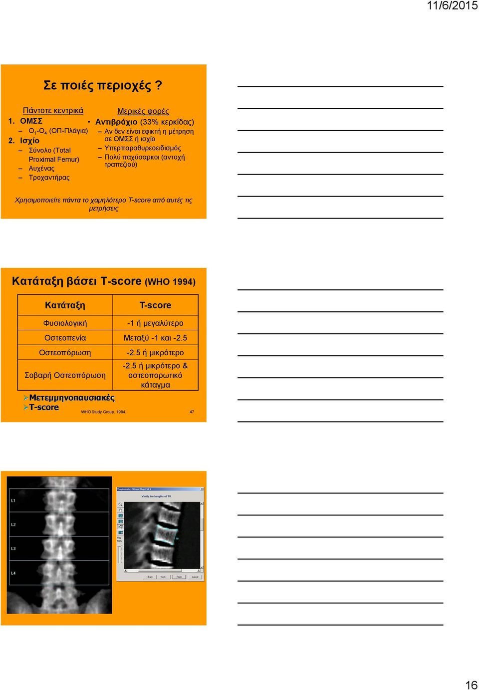 πάντα το χαμηλότερο T-score από αυτές τις μετρήσεις Κατάταξη βάσει T-score (WHO 1994) Κατάταξη T-score Φυσιολογική -1 ή μεγαλύτερο Οστεοπενία