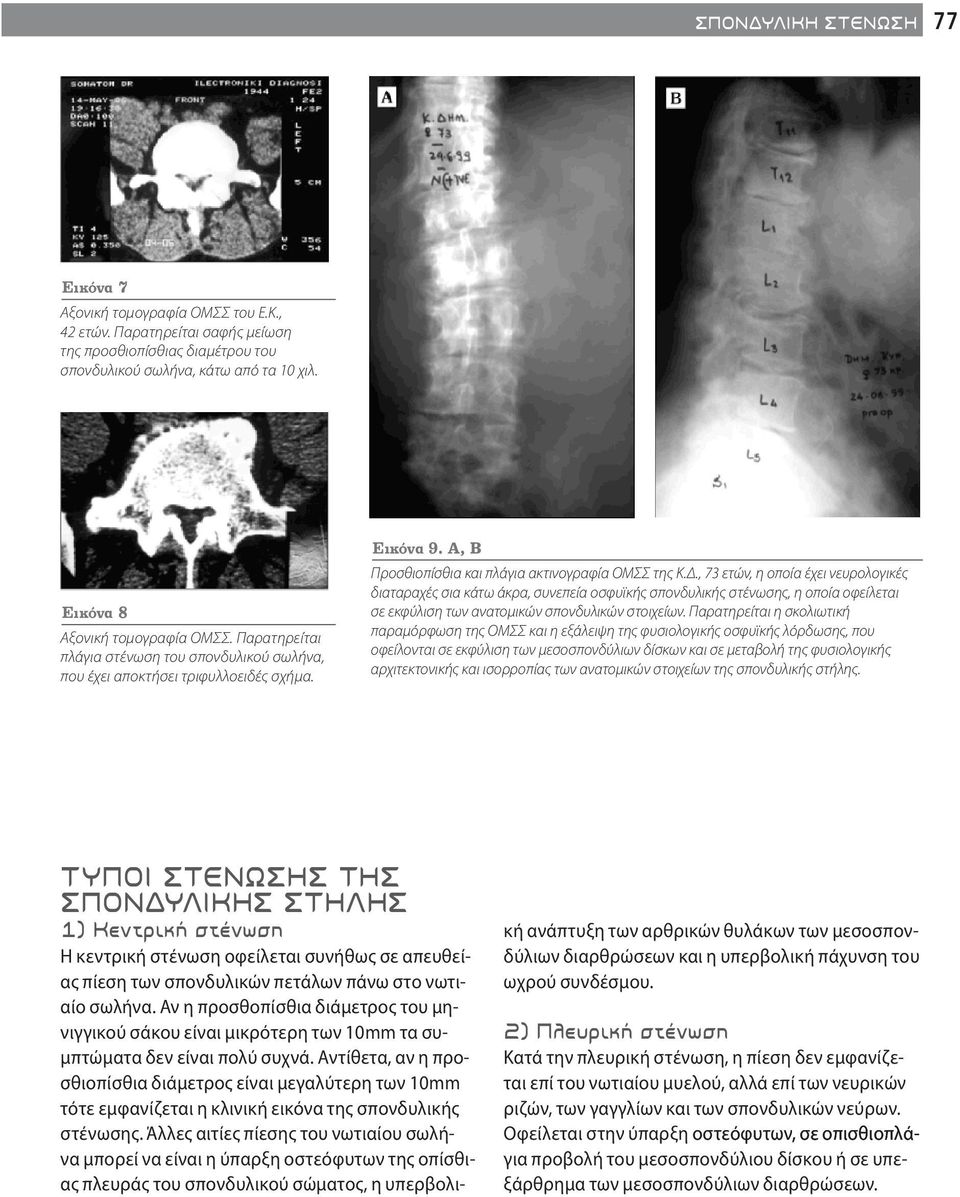 , 73 ετών, η οποία έχει νευρολογικές διαταραχές σια κάτω άκρα, συνεπεία οσφυϊκής σπονδυλικής στένωσης, η οποία οφείλεται σε εκφύλιση των ανατομικών σπονδυλικών στοιχείων.