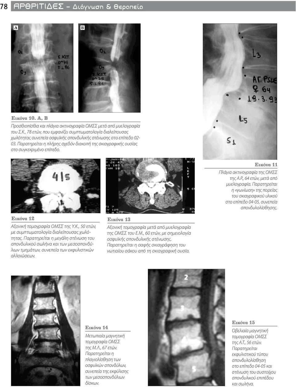 Παρατηρείται η πλήρης σχεδόν διακοπή της σκιαγραφικής ουσίας στο συγκεκριμένο επίπεδο. Εικόνα 11 Πλάγια ακτινογραφία της ΟΜΣΣ της Α.Ρ., 64 ετών, μετά από μυελογραφία.