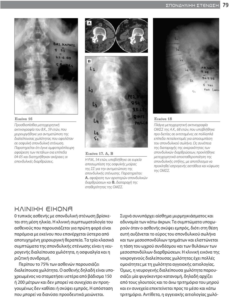 , 54 ετών, υποβλήθηκε σε ευρεία αποσυμπίεση της οσφυϊκής μοίρας της ΣΣ για την αντιμετώπιση της σπονδυλικής στένωσης. Παρατηρείται: Α. αφαίρεση των αριστερών σπονδυλικών διαρθρώσεων και Β.