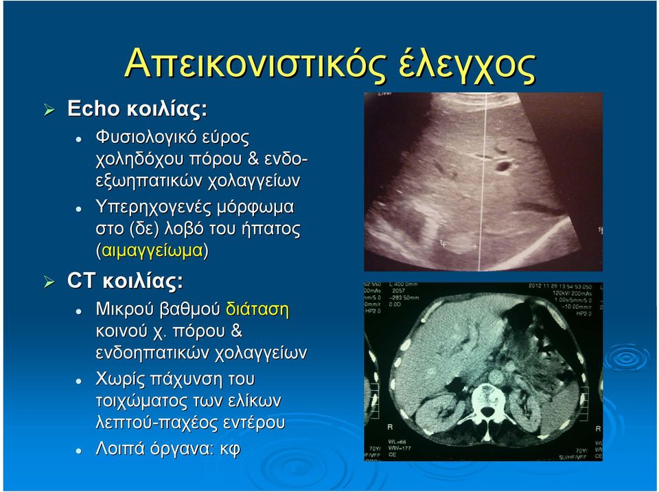 (αιμαγγείωμα) CT κοιλίας: Μικρού βαθμού διάταση κοινού χ.