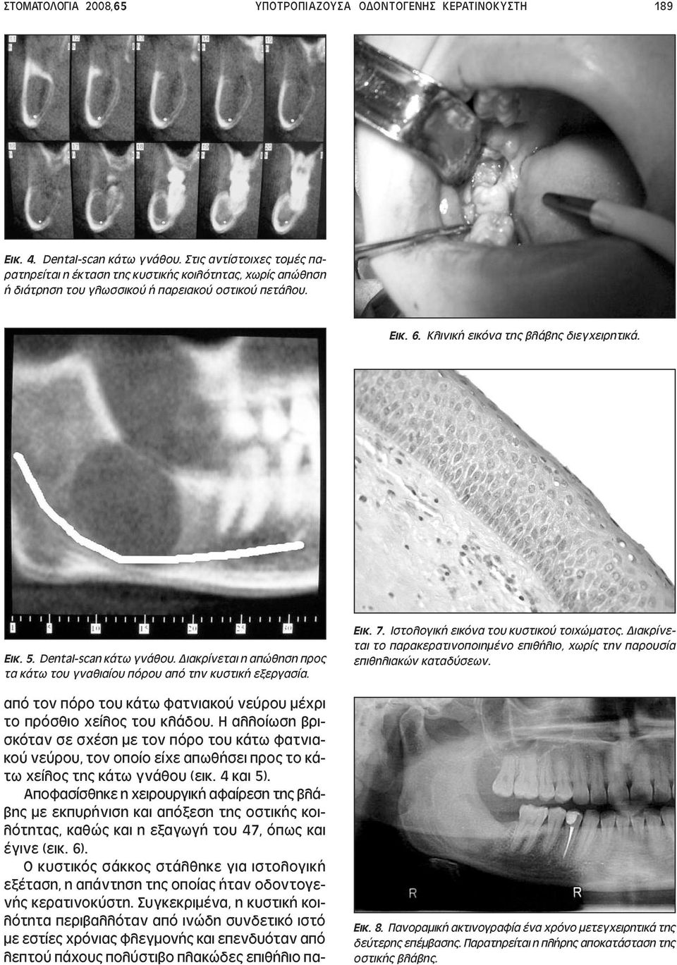 Dental-scan κάτω γνάθου. ιακρίνεται η απώθηση προς τα κάτω του γναθιαίου πόρου από την κυστική εξεργασία. από τον πόρο του κάτω φατνιακού νεύρου µέχρι το πρόσθιο χείλος του κλάδου.