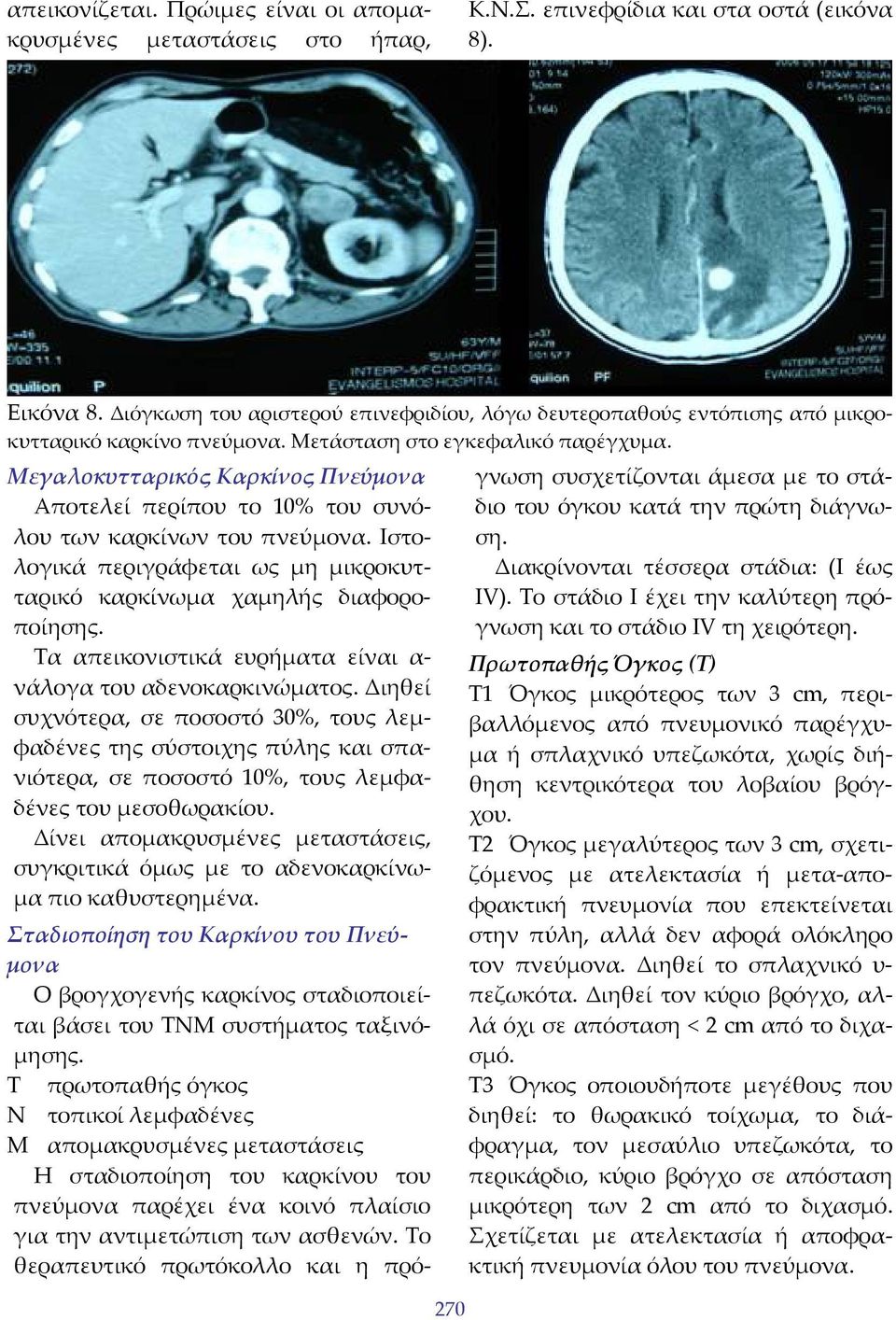 Μεγαλοκυτταρικός Καρκίνος Πνεύμονα Αποτελεί περίπου το 10% του συνόλου των καρκίνων του πνεύμονα. Ιστολογικά περιγράφεται ως μη μικροκυτταρικό καρκίνωμα χαμηλής διαφοροποίησης.