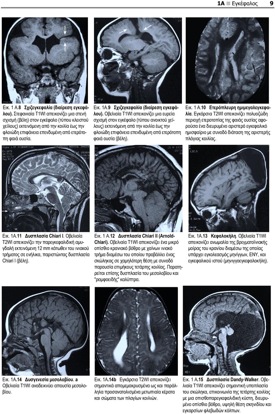 9 Σχιζεγκεφαλία (διαίρεση εγκεφάλου).
