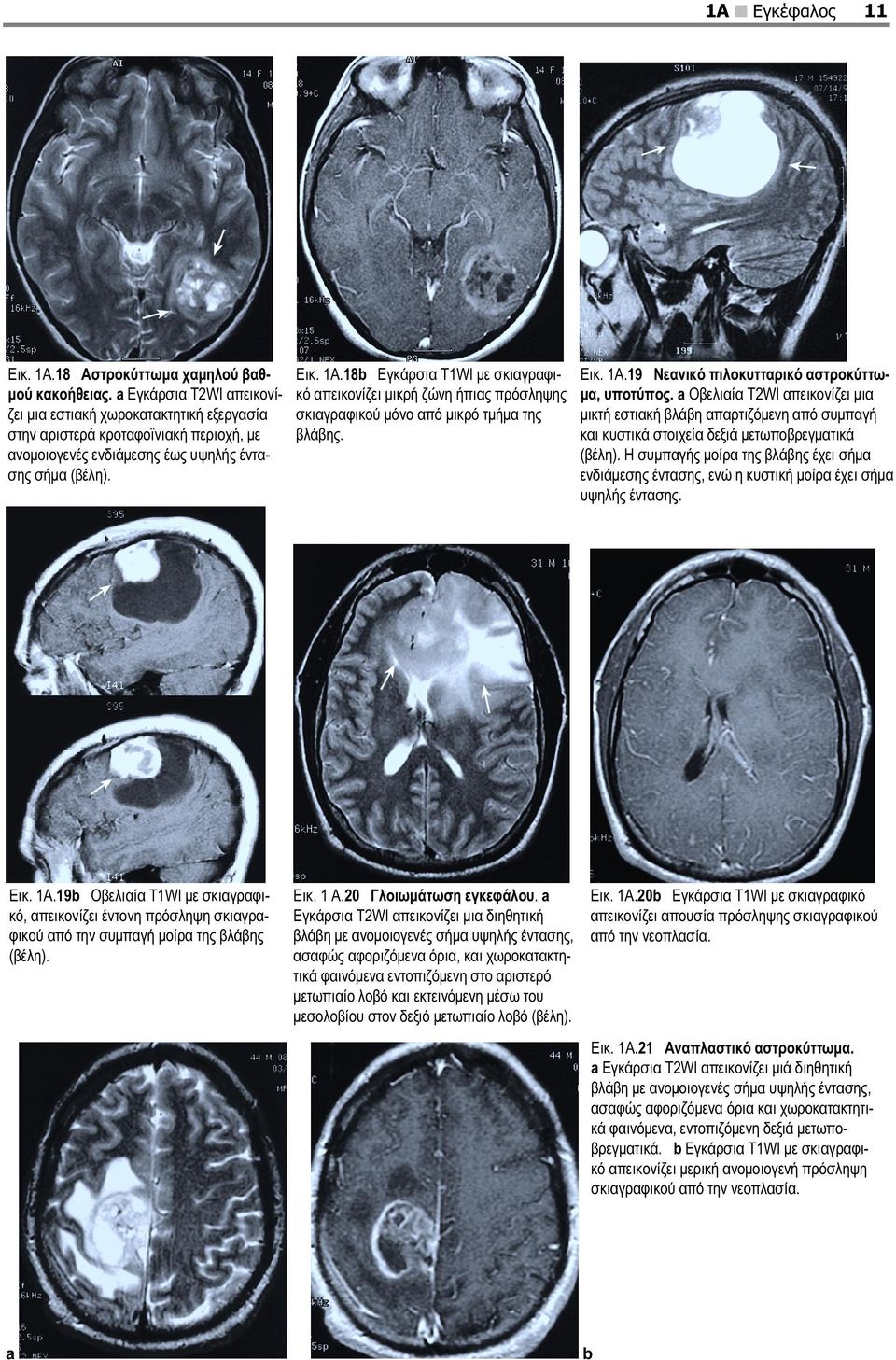 18b Εγκάρσια T1WI με σκιαγραφικό απεικονίζει μικρή ζώνη ήπιας πρόσληψης σκιαγραφικού μόνο από μικρό τμήμα της βλάβης. Εικ. 1A.19 Νεανικό πιλοκυτταρικό αστροκύττωμα, υποτύπος.