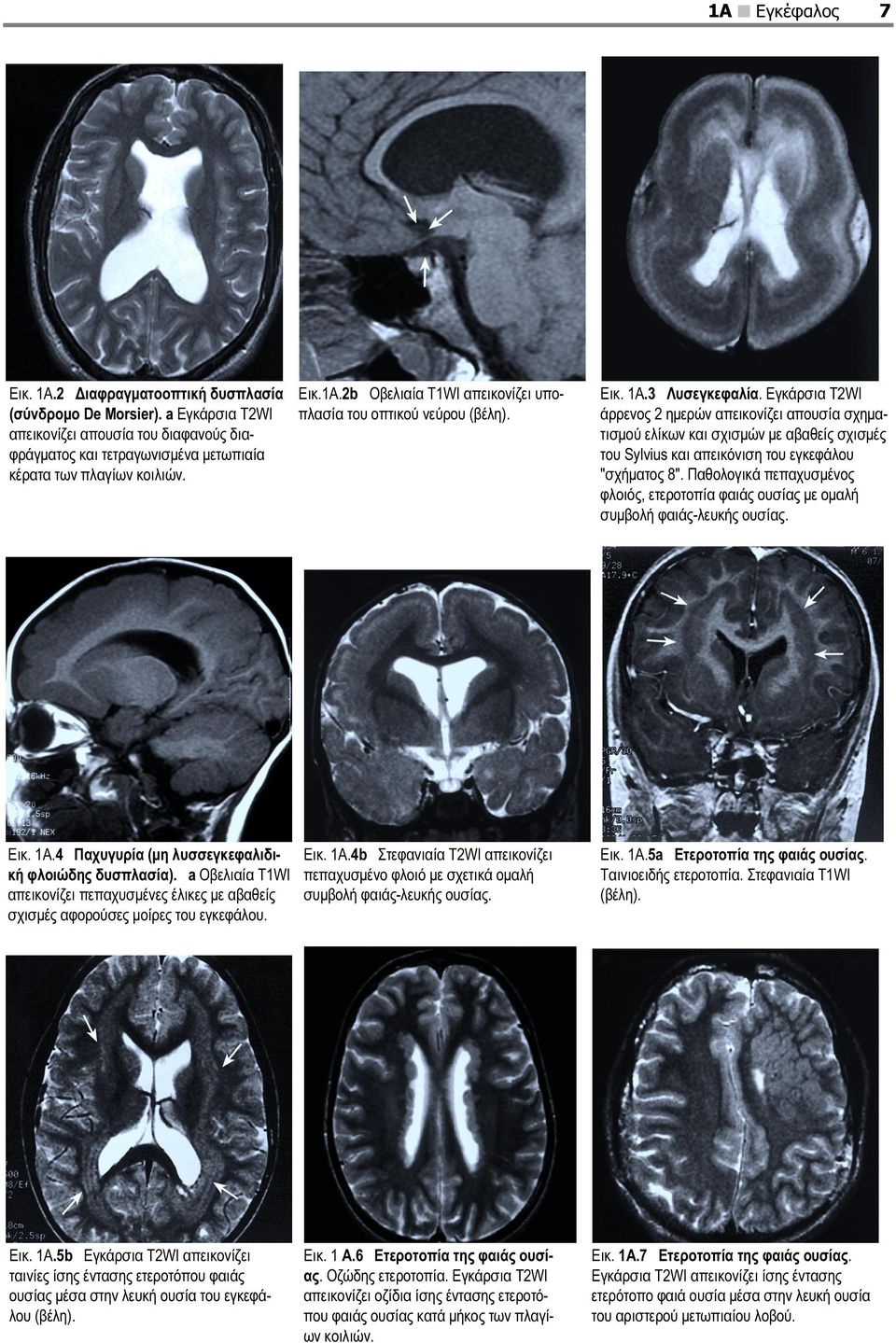 Εγκάρσια T2WI άρρενος 2 ημερών απεικονίζει απουσία σχηματισμού ελίκων και σχισμών με αβαθείς σχισμές του Sylvius και απεικόνιση του εγκεφάλου "σχήματος 8".
