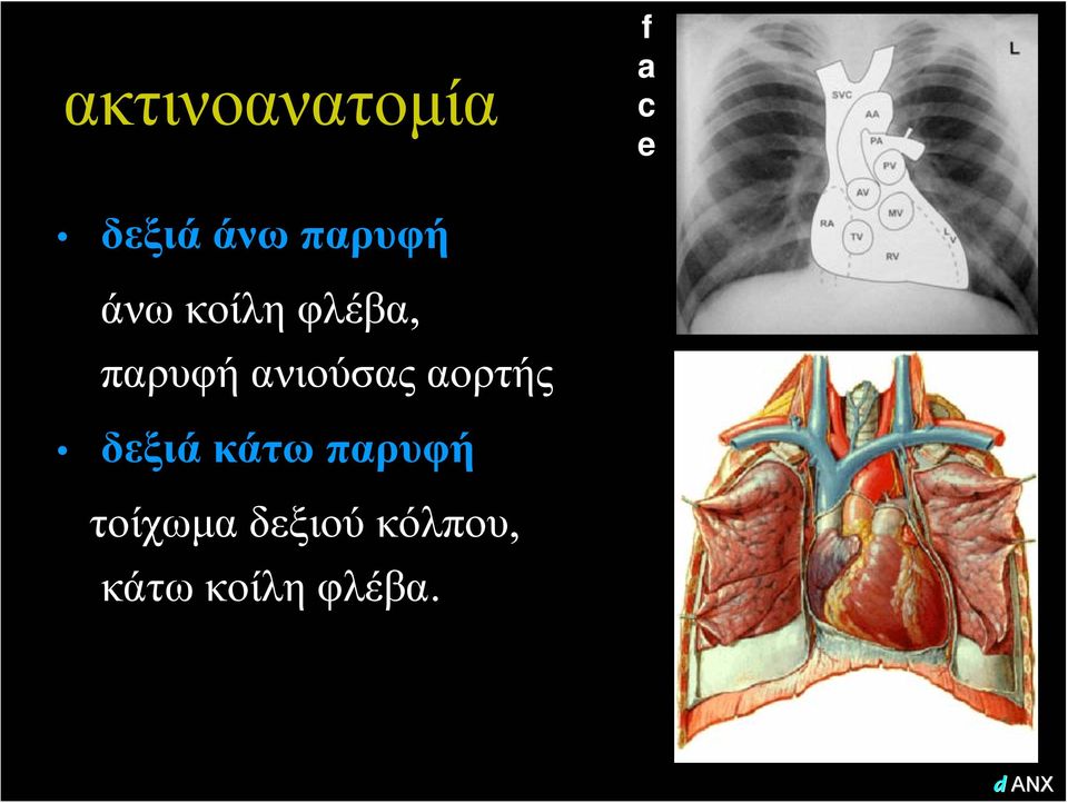 ανιούσας αορτής δεξιά κάτω παρυφή