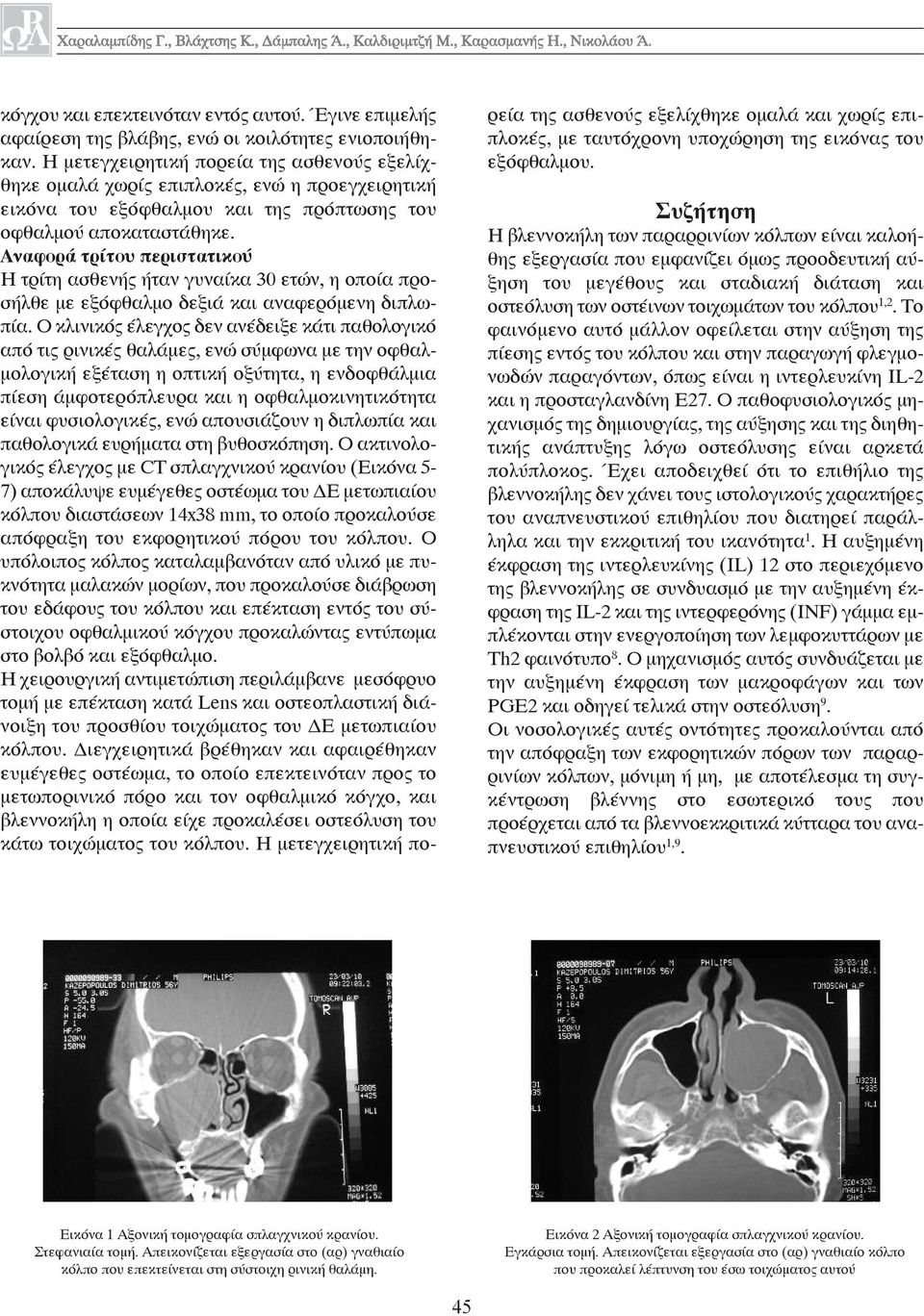 Αναφορά τρίτου περιστατικού Η τρίτη ασθενής ήταν γυναίκα 30 ετών, η οποία προσήλθε με εξόφθαλμο δεξιά και αναφερόμενη διπλωπία.