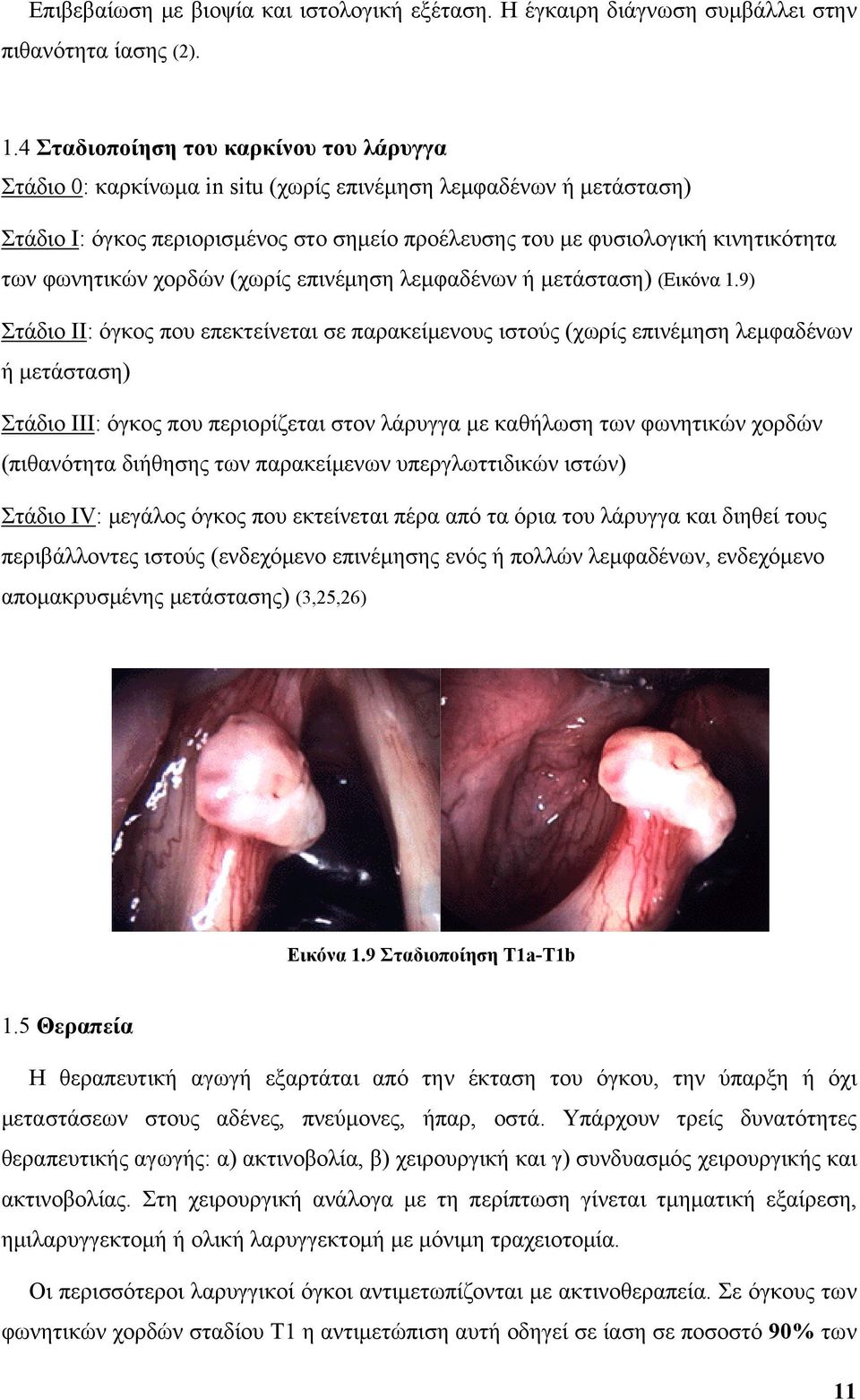φωνητικών χορδών (χωρίς επινέμηση λεμφαδένων ή μετάσταση) (Εικόνα 1.