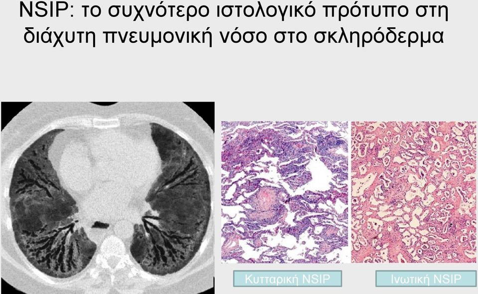 διάχυτη πνευμονική νόσο στο