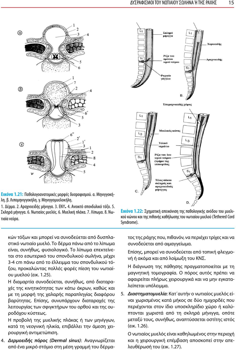 22: Σχηματική απεικόνιση της παθολογικής ανόδου του μυελικού κώνου και της πιθανής καθήλωσης του νωτιαίου μυελού (Tethered Cord Syndrome).