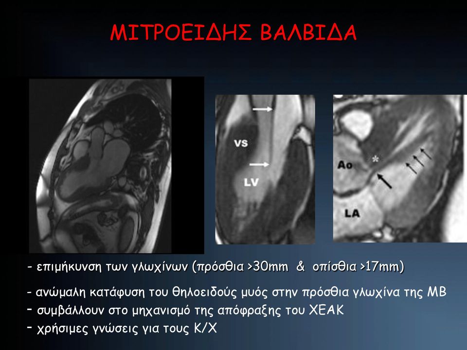 µυός στην πρόσθια γλωχίνα της ΜΒ - συµβάλλουν στο