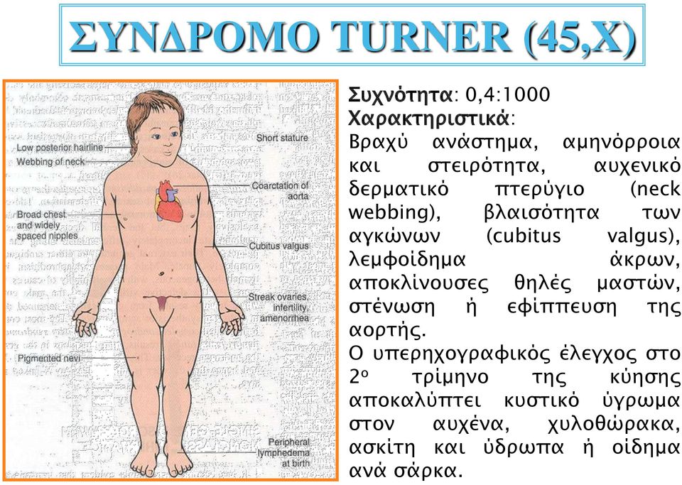 άκρων, αποκλίνουσες θηλές μαστών, στένωση ή εφίππευση της αορτής.