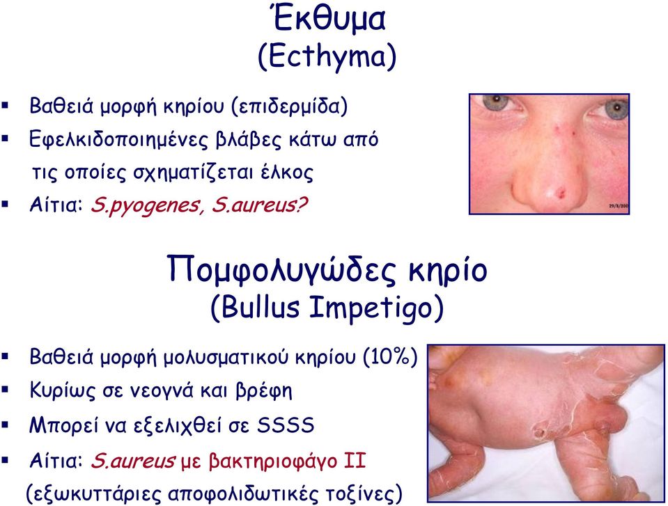 Πομφολυγώδες κηρίο (Bullus Impetigo) Βαθειά μορφή μολυσματικού κηρίου (10%) Κυρίως σε