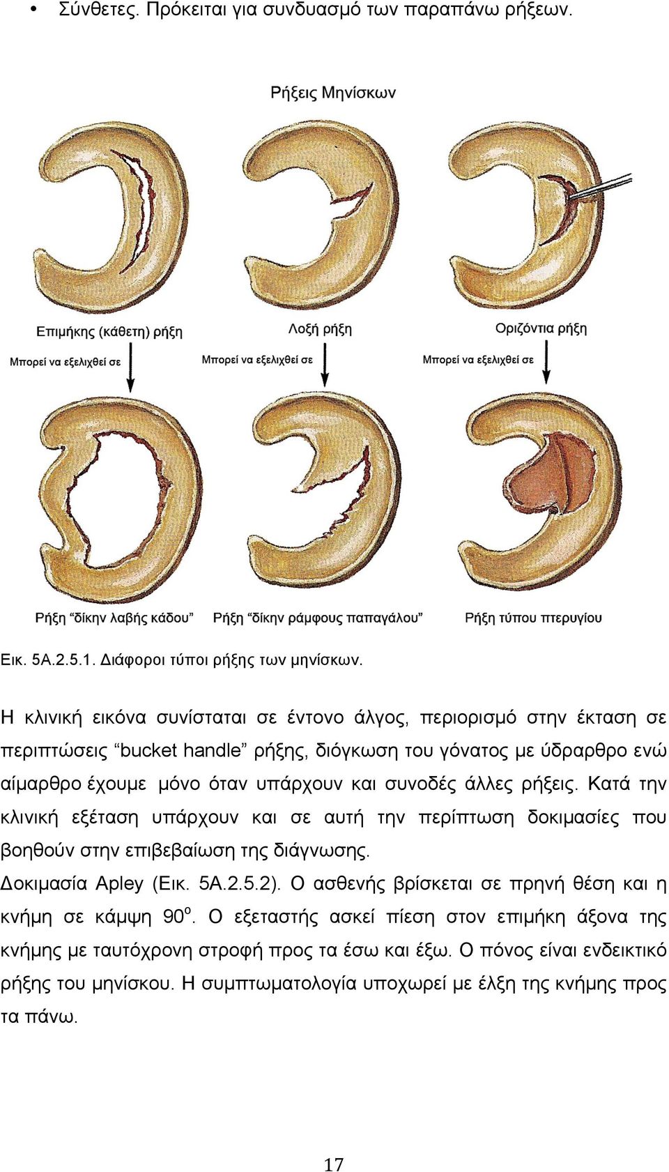 συνοδές άλλες ρήξεις. Κατά την κλινική εξέταση υπάρχουν και σε αυτή την περίπτωση δοκιµασίες που βοηθούν στην επιβεβαίωση της διάγνωσης. Δοκιµασία Apley (Εικ. 5Α.2.5.2).