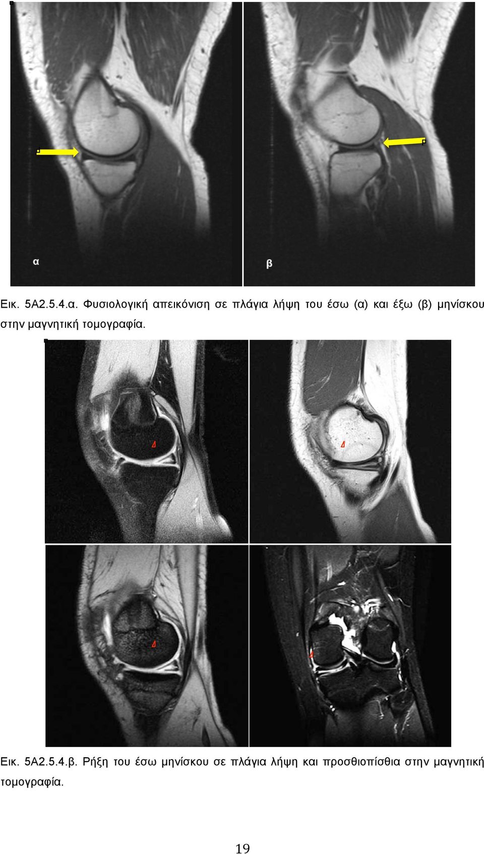 έξω (β) µηνίσκου στην µαγνητική τοµογραφία. Εικ. 5Α2.