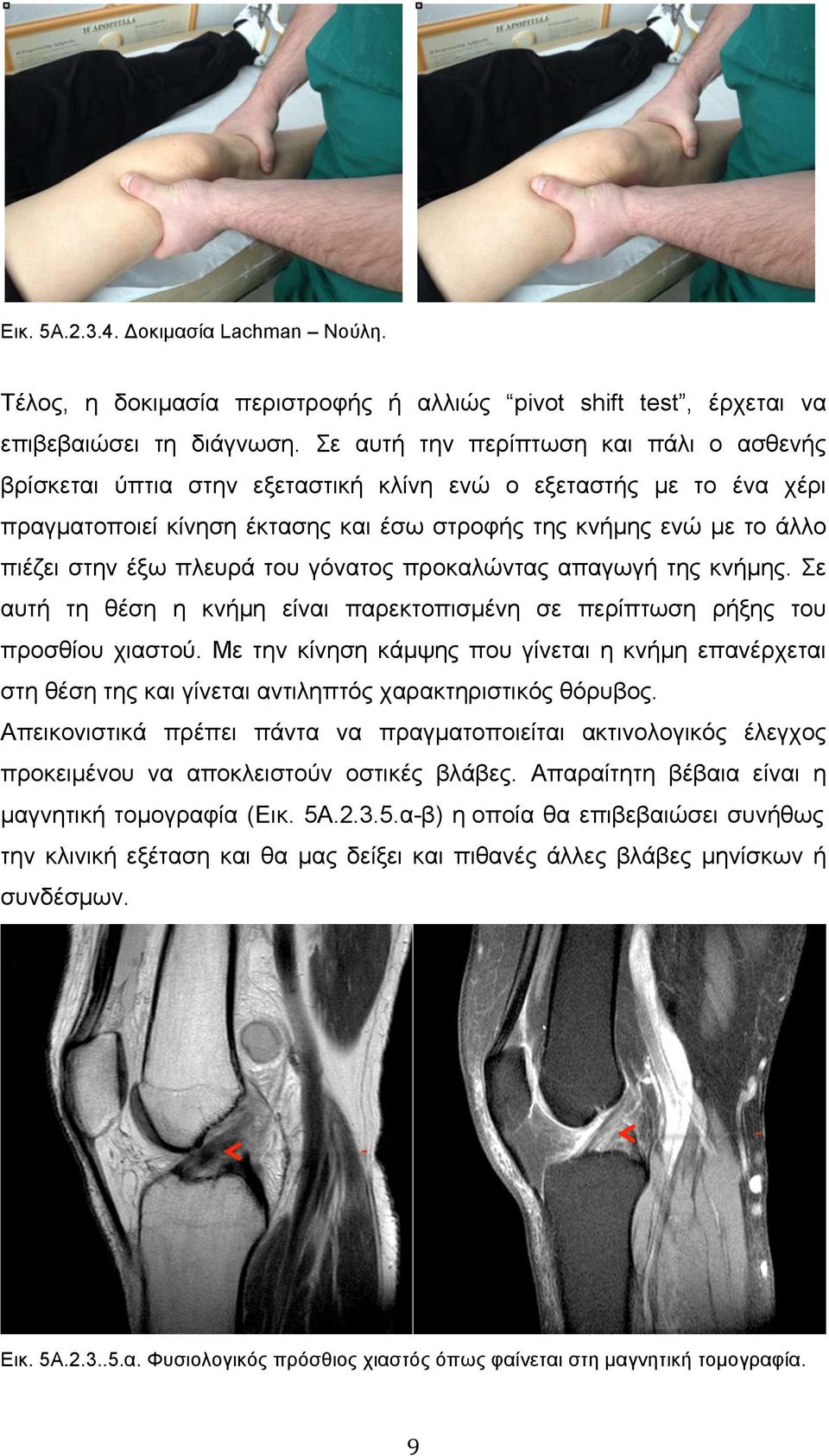 πλευρά του γόνατος προκαλώντας απαγωγή της κνήµης. Σε αυτή τη θέση η κνήµη είναι παρεκτοπισµένη σε περίπτωση ρήξης του προσθίου χιαστού.