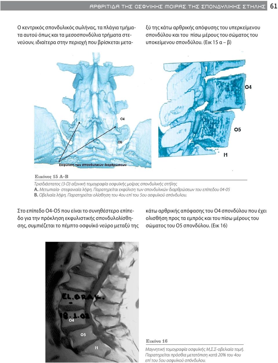 (Εικ 15 α β) Εικόνες 15 Α-Β Τρισδιάστατος (3-D) αξονική τομογραφία οσφυϊκής μοίρας σπονδυλικής στήλης Α. Μετωπιαία- στεφανιαία λήψη.