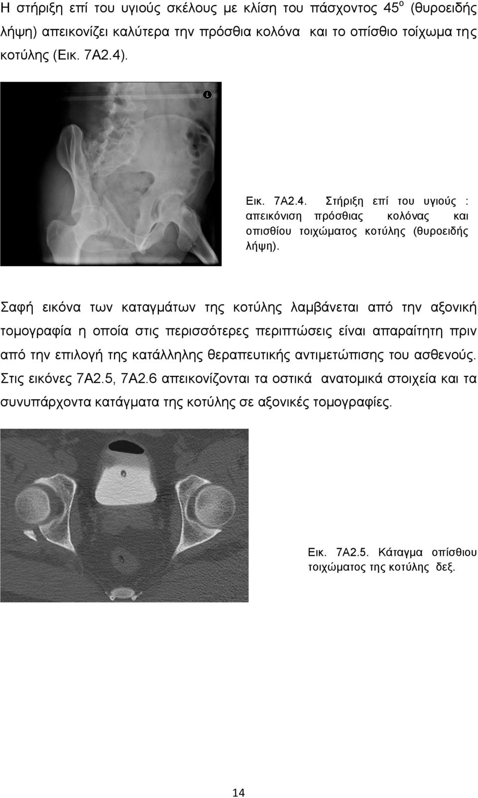 Σαφή εικόνα των καταγµάτων της κοτύλης λαµβάνεται από την αξονική τοµογραφία η οποία στις περισσότερες περιπτώσεις είναι απαραίτητη πριν από την επιλογή της κατάλληλης