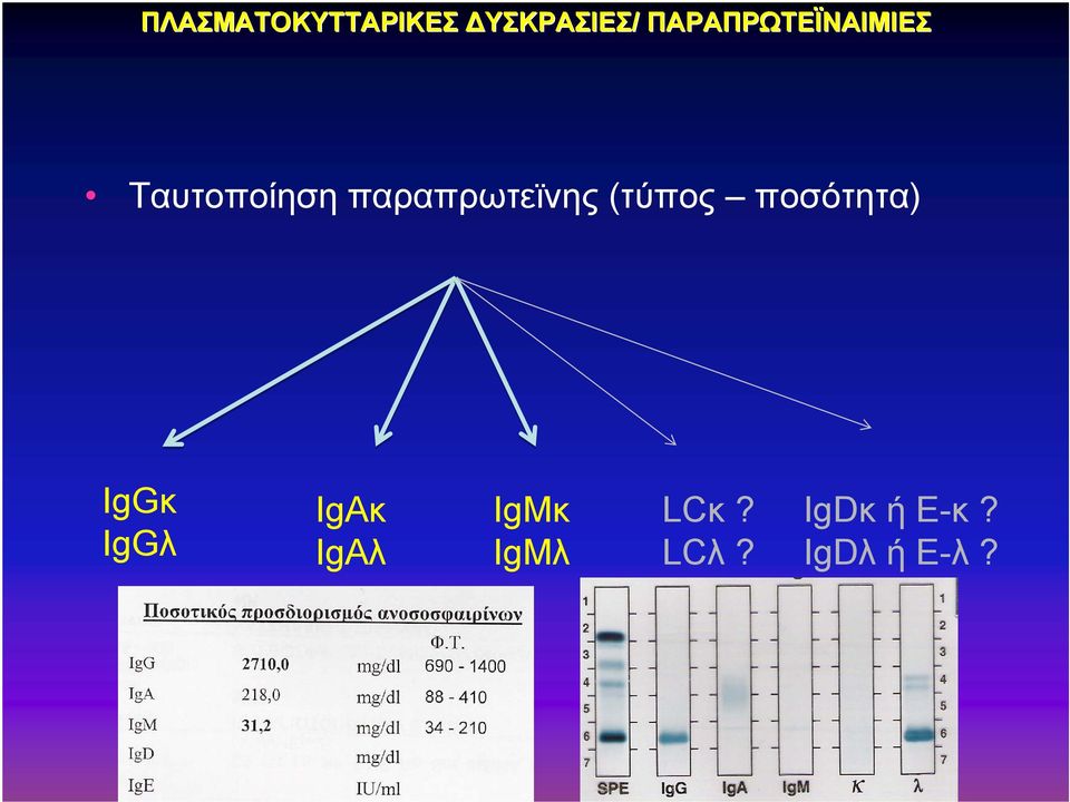 παραπρωτεϊνης (τύπος ποσότητα) IgGκ