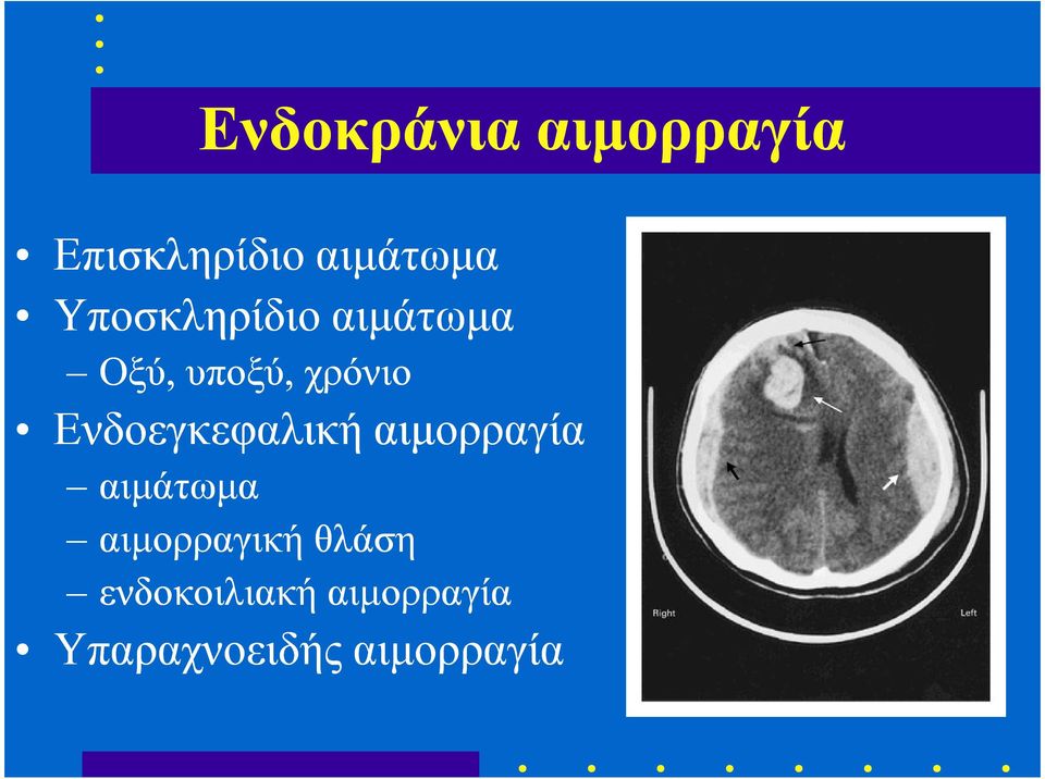 Ενδοεγκεφαλική αιµορραγία αιµάτωµα αιµορραγική