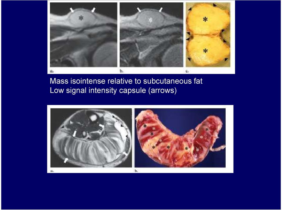 subcutaneous fat Low