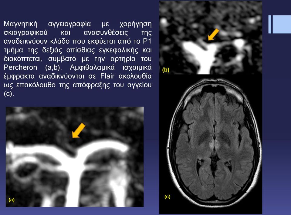 διακόπτεται, συμβατό με την αρτηρία του Percheron (a,b).