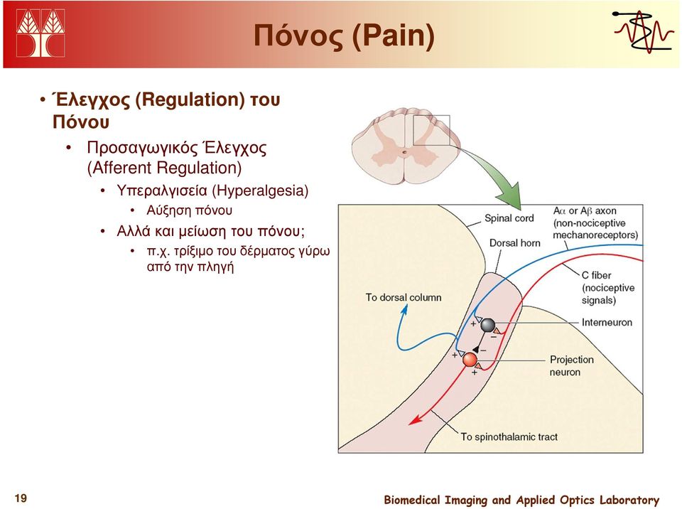 Υπεραλγισεία (Hyperalgesia) Αύξηση πόνου Αλλά και