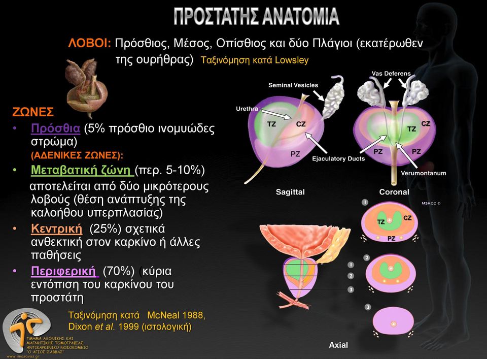 5-10%) αποτελείται από δύο μικρότερους λοβούς (θέση ανάπτυξης της καλοήθου υπερπλασίας) Κεντρική (25%) σχετικά ανθεκτική