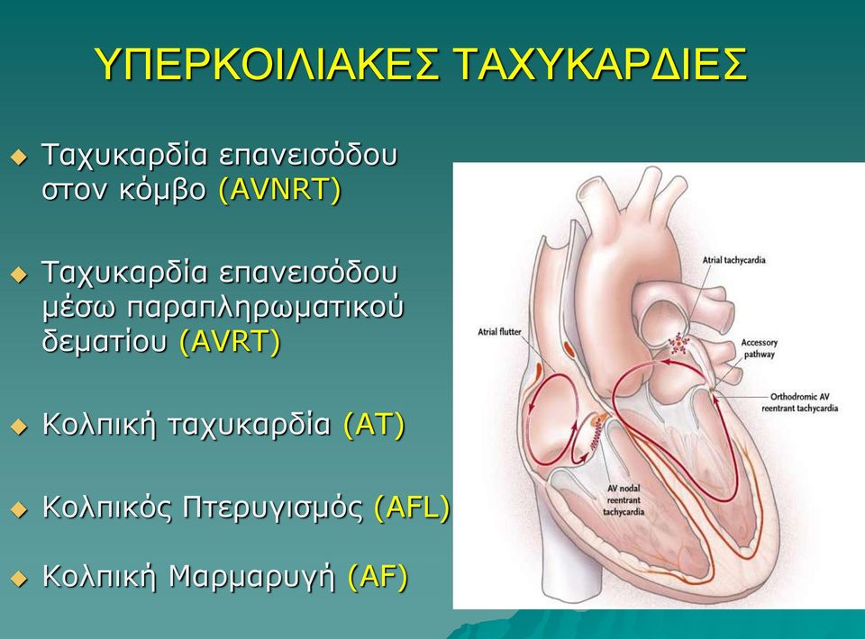 παραπληρωματικού δεματίου (AVRT) Κολπική