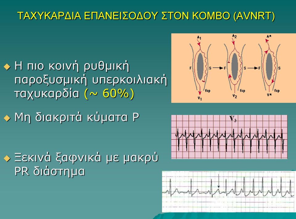 υπερκοιλιακή ταχυκαρδία (~ 60%) Μη