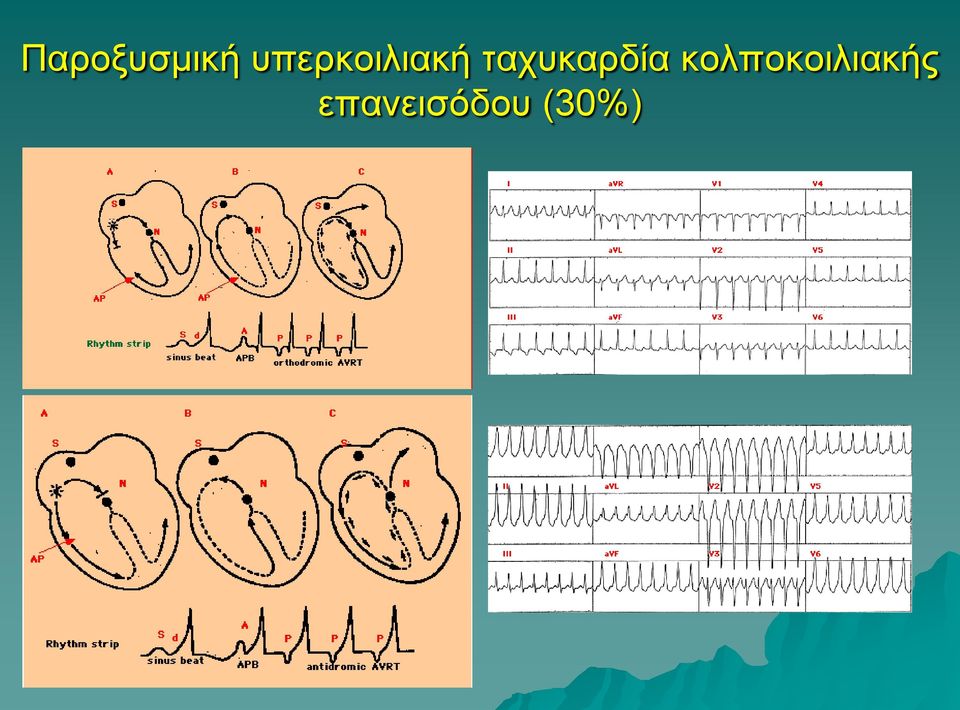 ταχυκαρδία