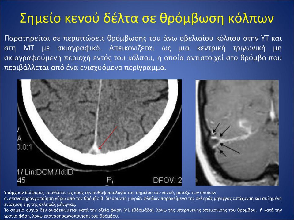 Υπάρχουν διάφορες υποθέσεις ως προς την παθοφυσιολογία του σημείου του κενού, μεταξύ των οποίων: α. επανασηραγγοποίηση γύρω απο τον θρόμβο β.