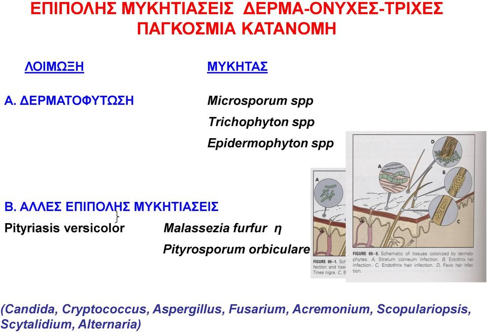 ΑΛΛΕΣ ΕΠΙΠΟΛΗΣ ΜΥΚΗΤΙΑΣΕΙΣ Pityriasis versicolor Malassezia furfur η Pityrosporum