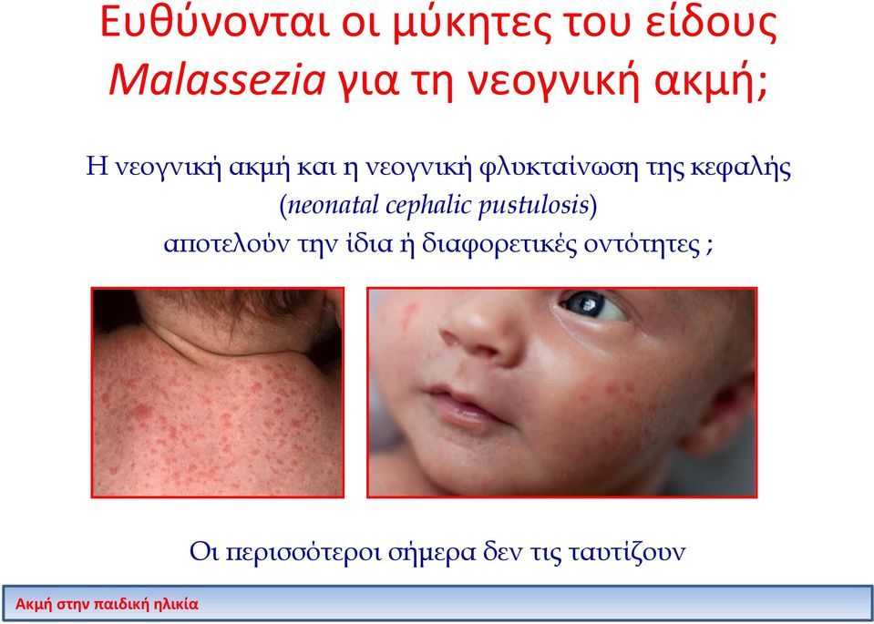 κεφαλής (neonatal cephalic pustulosis) αποτελούν την ίδια ή