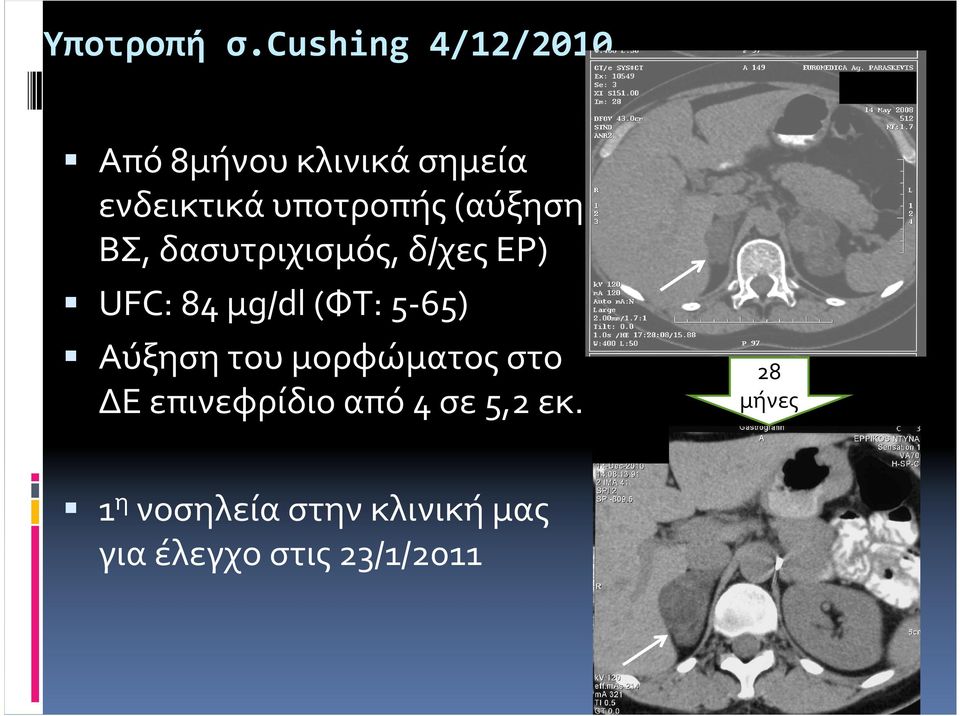 υποτροπής(αύξηση ΒΣ, δασυτριχισμός, δ/χες ΕΡ) UFC: 84 μg/dl