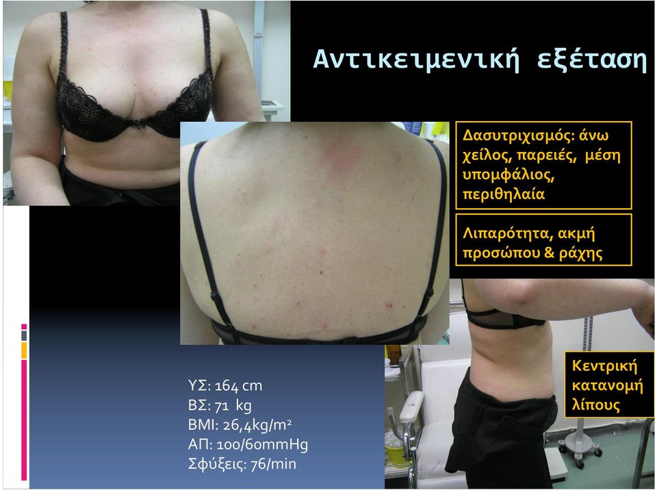 ακμή προσώπου& ράχης ΥΣ: 164cm ΒΣ: 71 kg BMI: