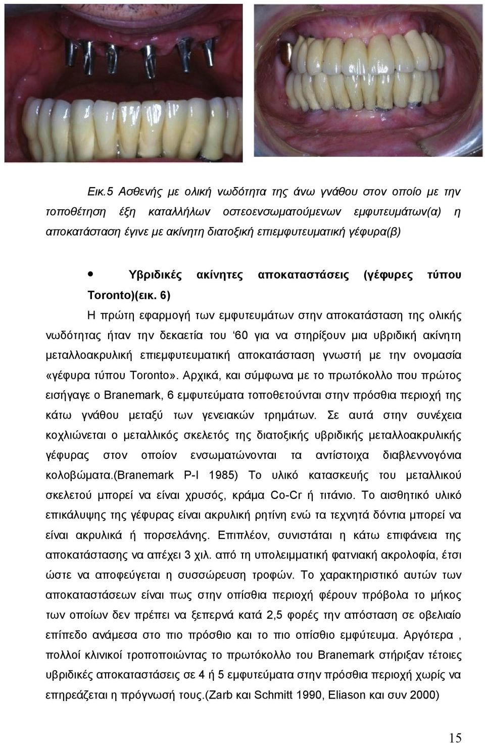 6) Η πρώτη εφαρμογή των εμφυτευμάτων στην αποκατάσταση της ολικής νωδότητας ήταν την δεκαετία του 60 για να στηρίξουν μια υβριδική ακίνητη μεταλλοακρυλική επιεμφυτευματική αποκατάσταση γνωστή με την