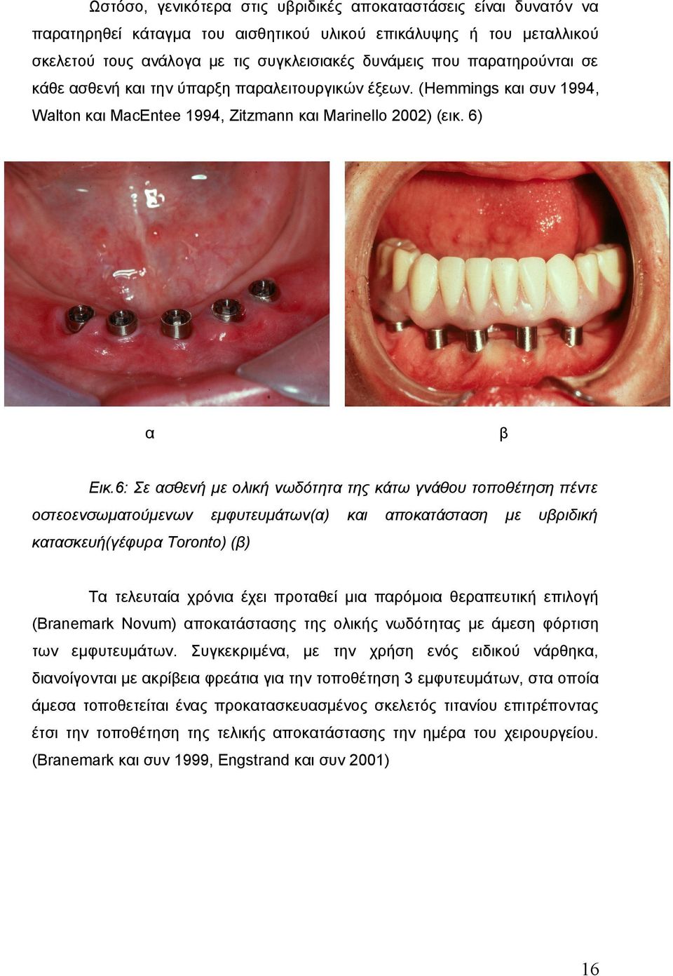 6: Σε ασθενή με ολική νωδότητα της κάτω γνάθου τοποθέτηση πέντε οστεοενσωματούμενων εμφυτευμάτων(α) και αποκατάσταση με υβριδική κατασκευή(γέφυρα Toronto) (β) Τα τελευταία χρόνια έχει προταθεί μια