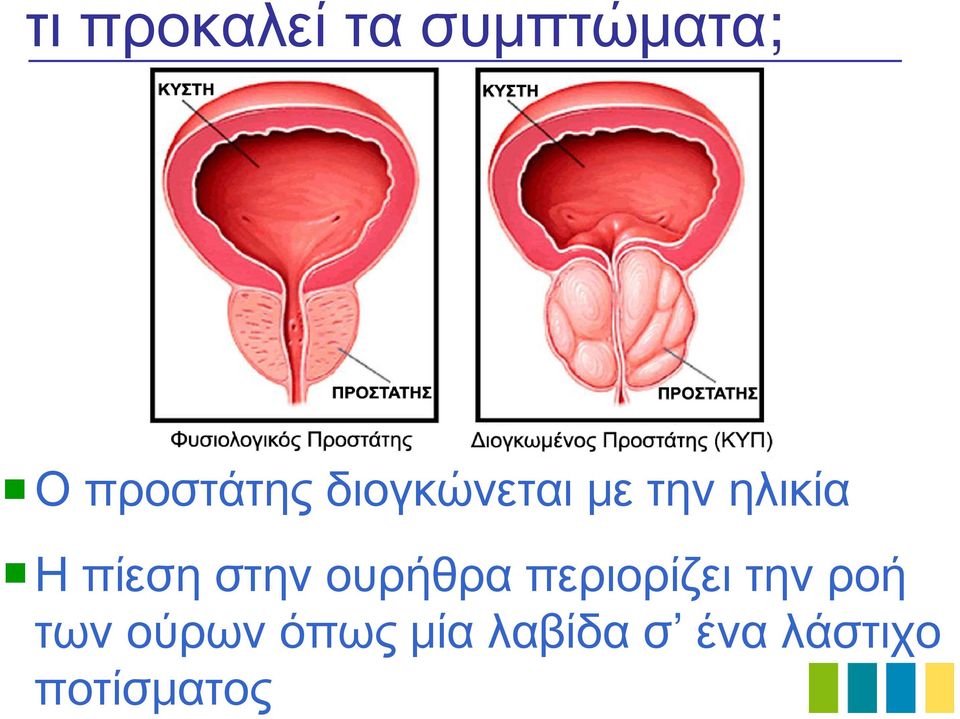 ουρήθρα περιορίζει την ροή των ούρων