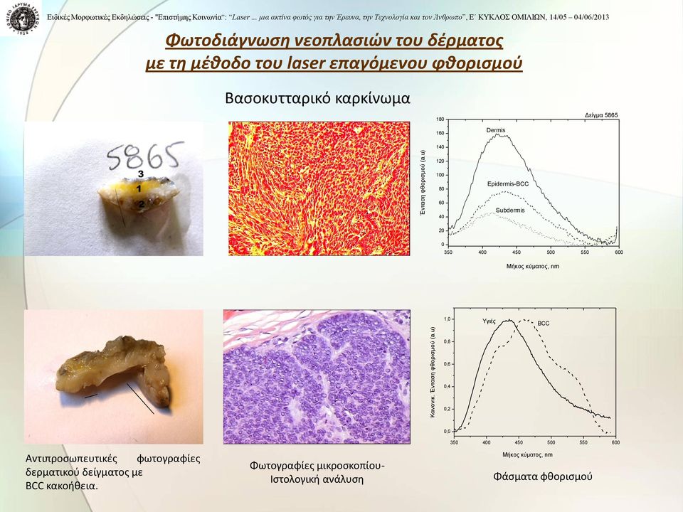 επαγόμενου φθορισμού Βασοκυτταρικό καρκίνωμα 180 160 Dermis Δείγμα 5865 140 120 100 80 60 40 Epidermis-BCC Subdermis 20 0 350 400 450 500 550 600 Μήκος κύματος,