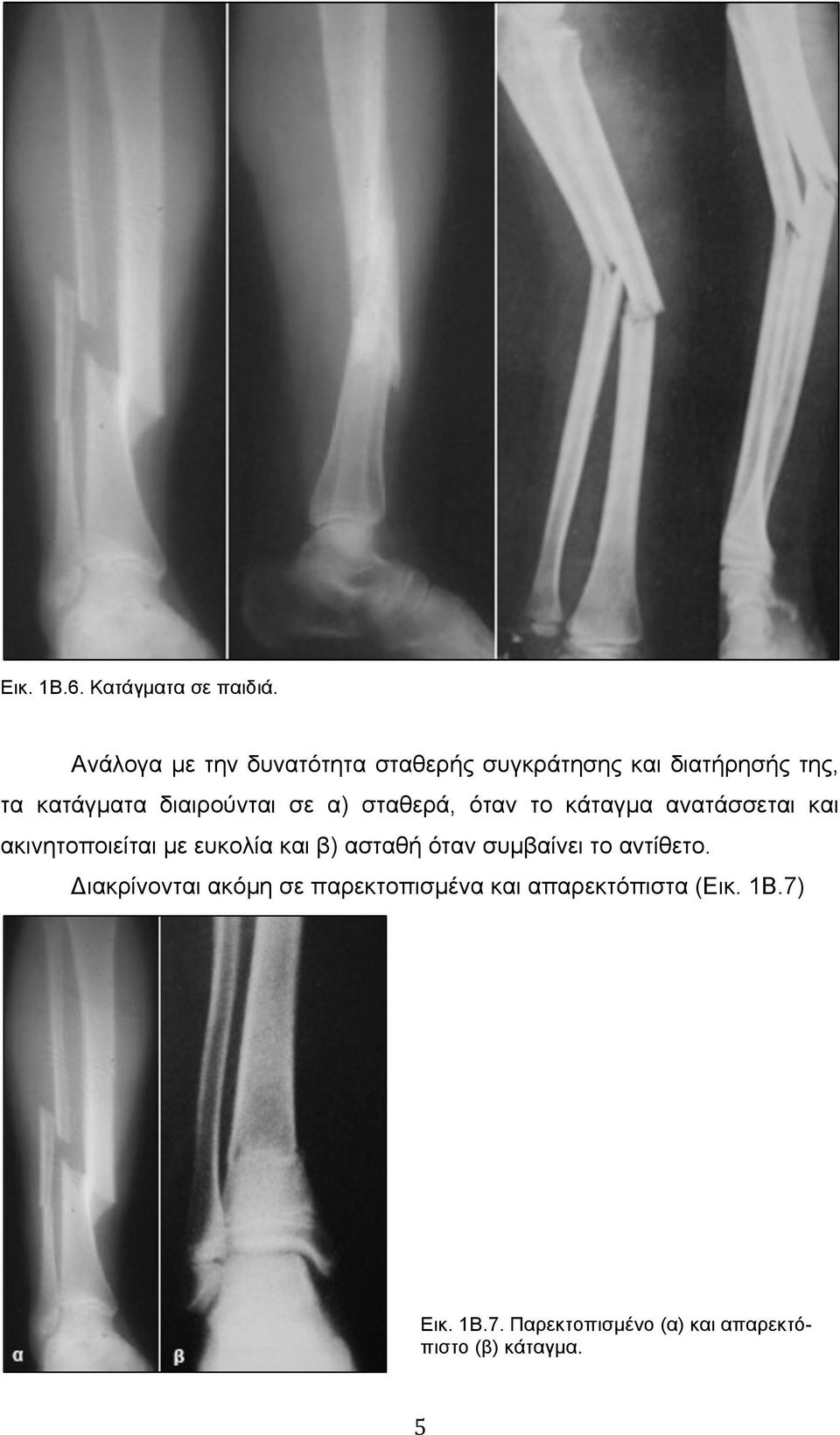 σε α) σταθερά, όταν το κάταγµα ανατάσσεται και ακινητοποιείται µε ευκολία και β) ασταθή όταν