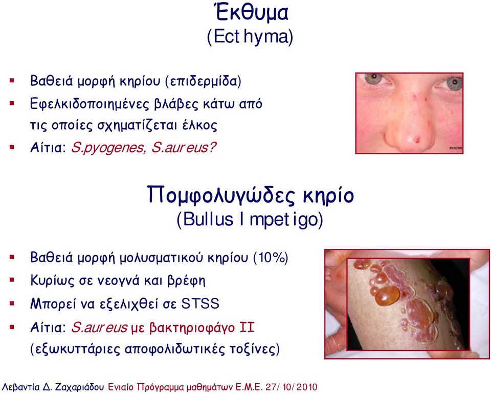 Πομφολυγώδες κηρίο (Bullus Impetigo) Βαθειά μορφή μολυσματικού κηρίου (10%) Κυρίως σε