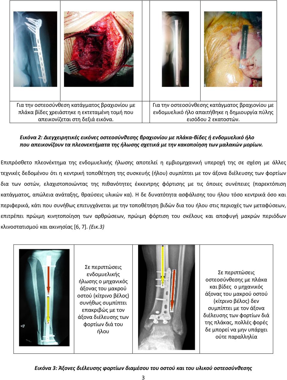 Εικόνα 2: Διεγχειρητικές εικόνες οστεοσύνθεσης βραχιονίου με πλάκα-βίδες ή ενδομυελικό ήλο που απεικονίζουν τα πλεονεκτήματα της ήλωσης σχετικά με την κακοποίηση των μαλακών μορίων.