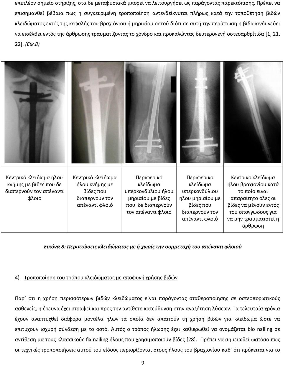 βίδα κινδυνεύει να εισέλθει εντός της άρθρωσης τραυματίζοντας το χόνδρο και προκαλώντας δευτερογενή οστεοαρθρίτιδα [1, 21, 22]. (Εικ.